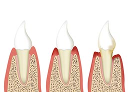 Parodontologie-zahnarzthannoverdental