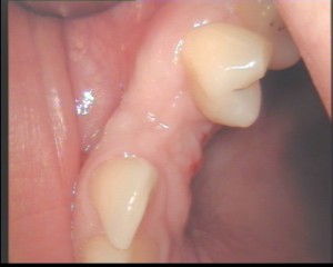 augmentieren-implantologie-zahnarzt-hannover-vorher-1
